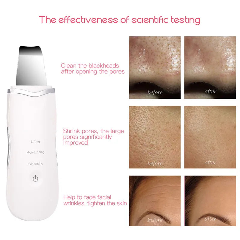 Ultrasonic Facial Skin Scrubber and Deep Pore Cleansing Spatula - 8