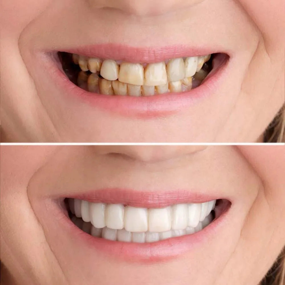 Snap On Smile Veneers Cosmetic Teeth Whitening Denture Set
