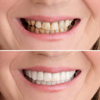 Snap On Smile Veneers Cosmetic Teeth Whitening Denture Set