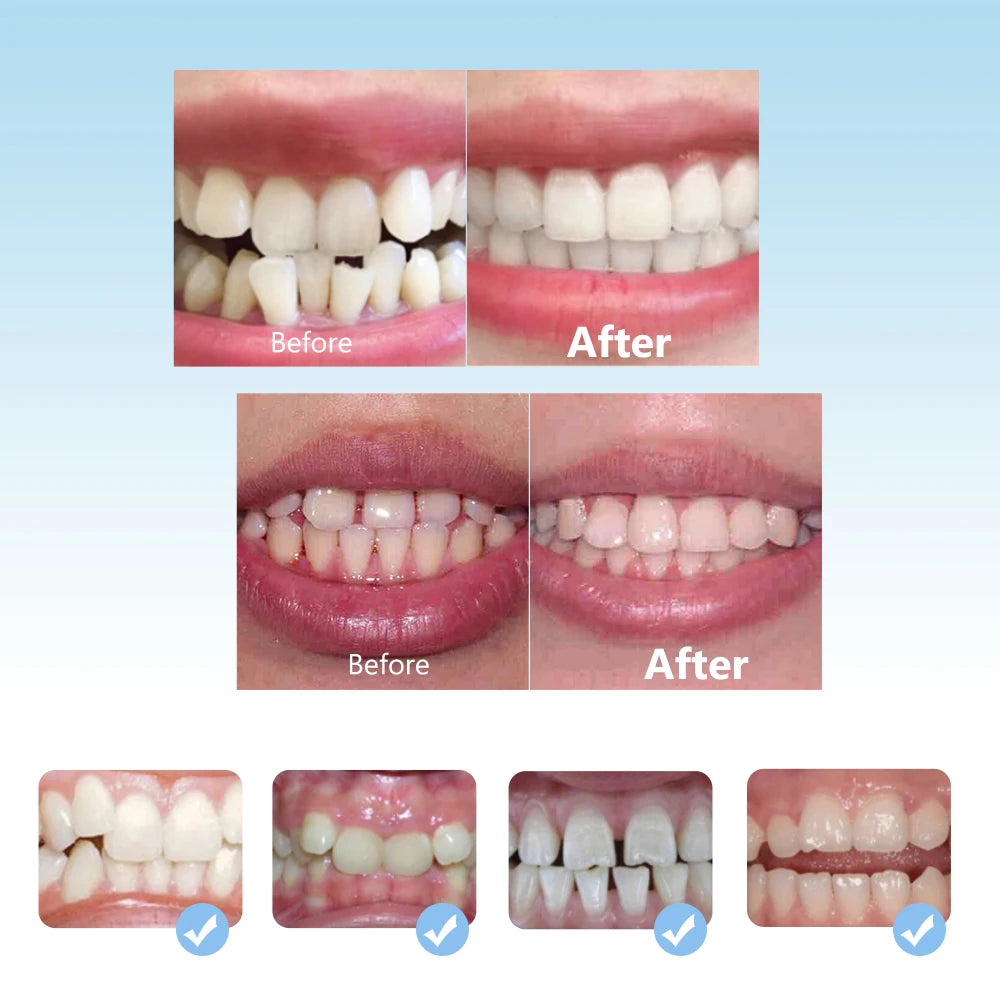 3-Stage Kids Orthodontic Teeth Alignment Trainer Set