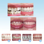 3-Stage Kids Orthodontic Teeth Alignment Trainer Set
