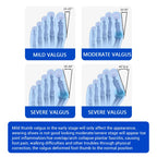 Adjustable Bunion Corrector for Hallux Valgus Pain Relief