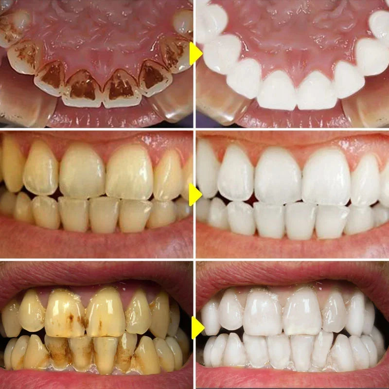 Probiotic Teeth Whitening Toothpaste for Stain Removal