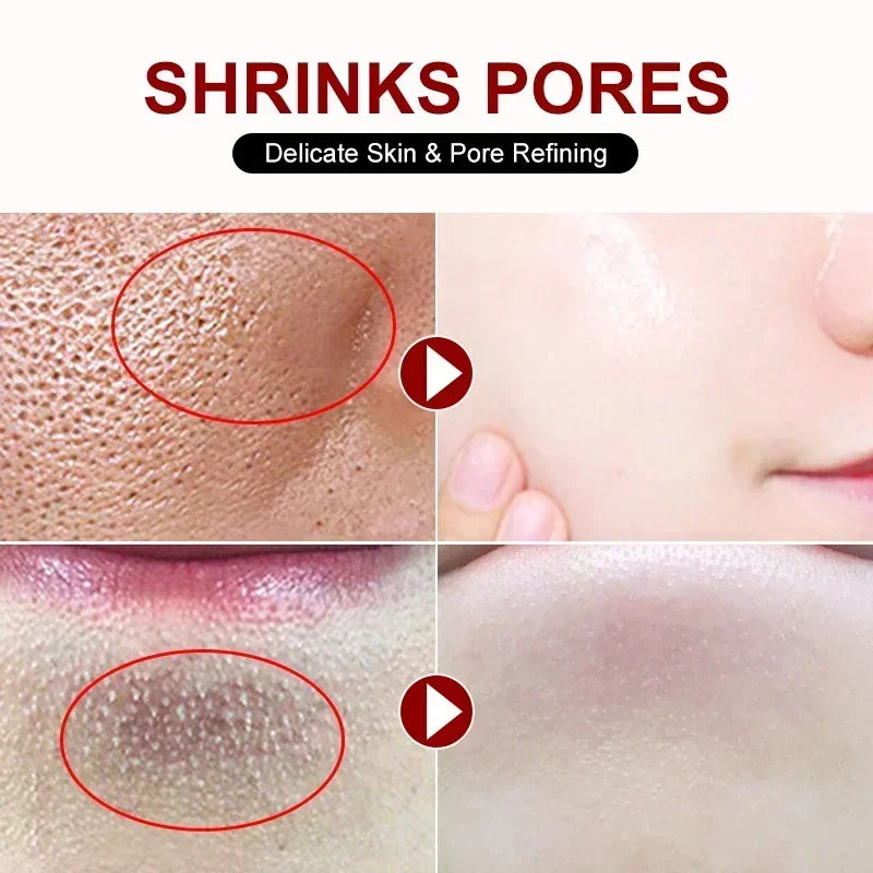 Salicylic Acid Pore Refining and Acne Repair Cream