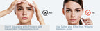 Professional Stainless Steel Blackhead and Pimple Extractor Tool Kit