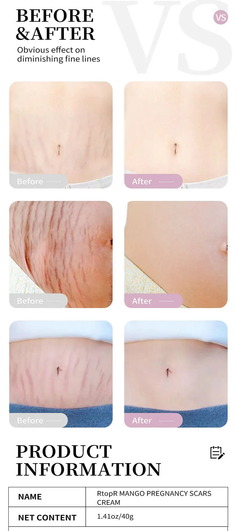 Mango Stretch Mark Cream and Repair Oil for Maternity Skin Care