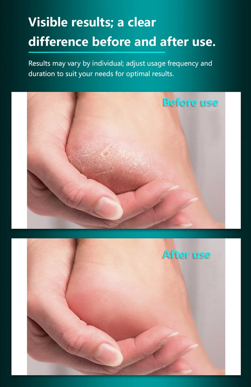 Professional Stainless Steel Foot File for Callus and Dead Skin Removal