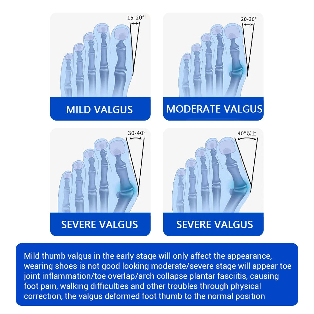 Adjustable Bunion Corrector and Toe Straightener Brace - 14
