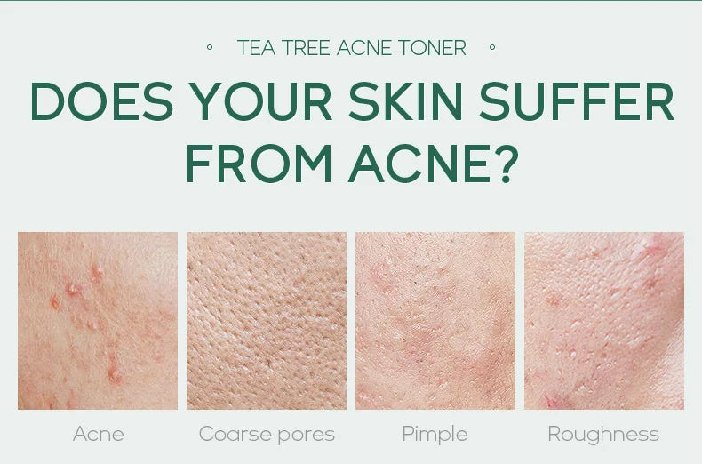 Fenyi Tea Tree Acne Toner Oil Control Facial Skin Care 100ml