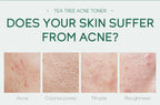 Fenyi Tea Tree Acne Toner Oil Control Facial Skin Care 100ml