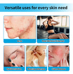 Hypochlorous Acid Facial Spray for Acne and Skin Soothing