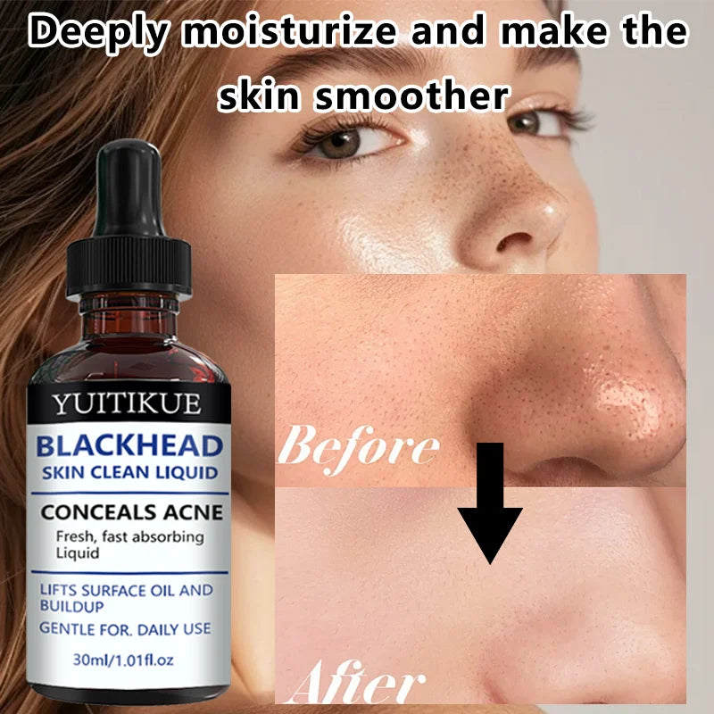 YUITIKUE Blackhead Remover Serum Pore Refining Face Treatment 30ml