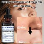 YUITIKUE Blackhead Remover Serum Pore Refining Face Treatment 30ml
