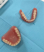 Temporary Cosmetic Denture Set for Instant Smile