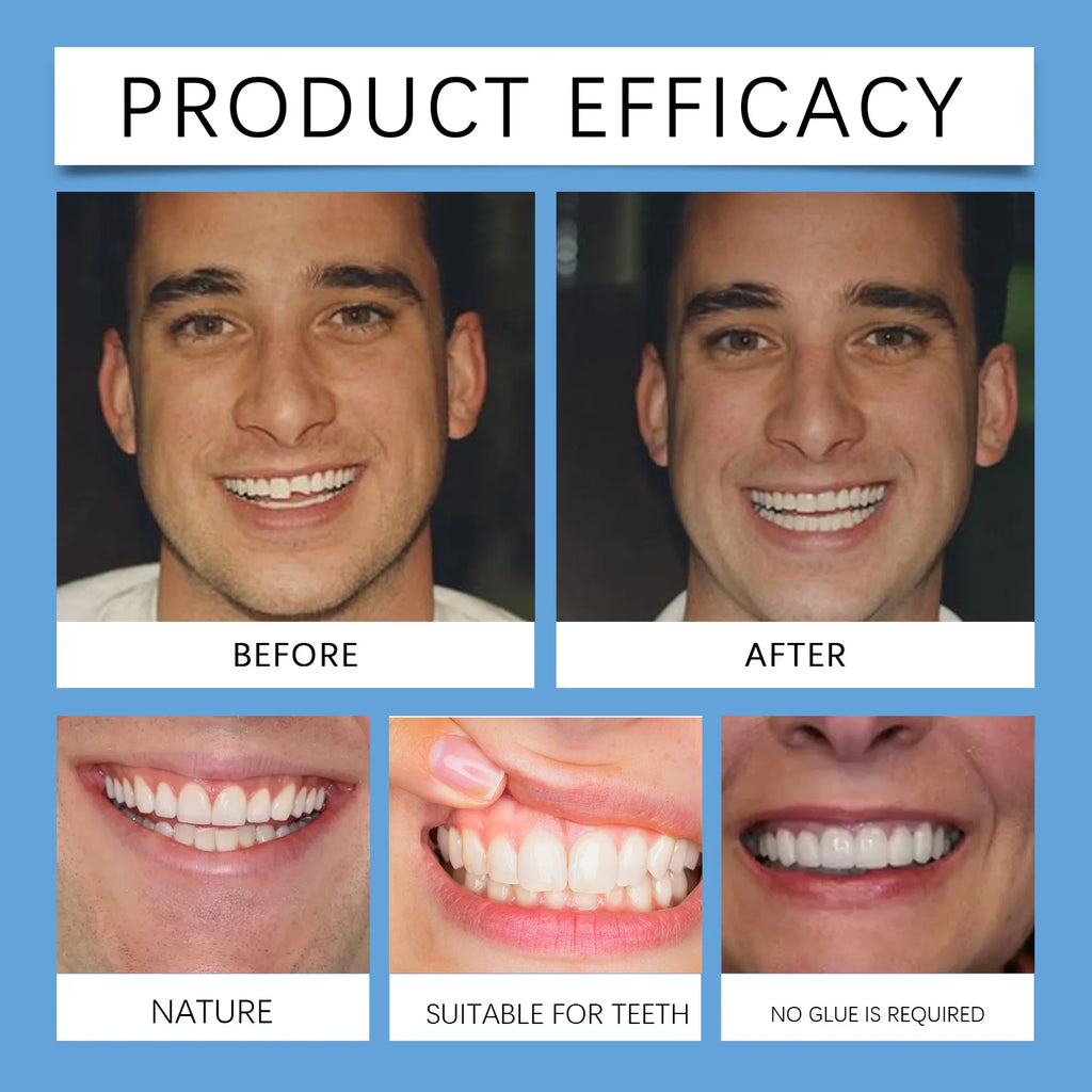 Adjustable Snap-On Smile Veneers for Missing Teeth