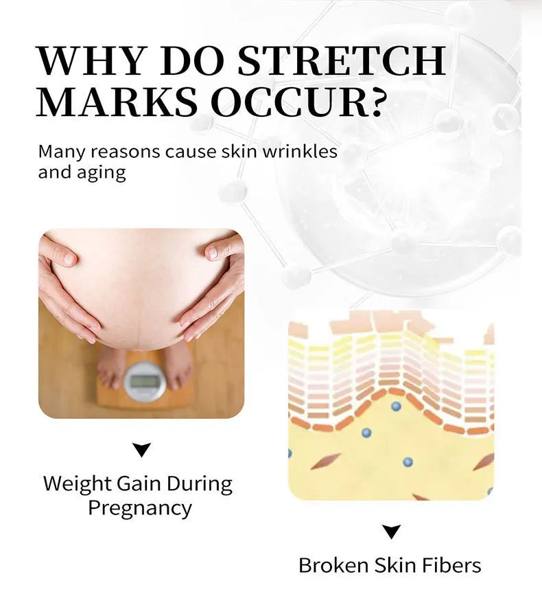 Mango Stretch Mark Cream and Repair Oil for Maternity Skin Care