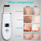 Ultrasonic Facial Skin Scrubber and Pore Cleaner