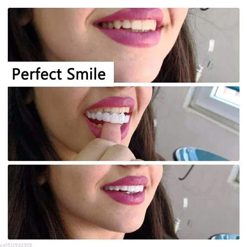 Snap-On Temporary Smile Veneers for Instant Teeth Whitening