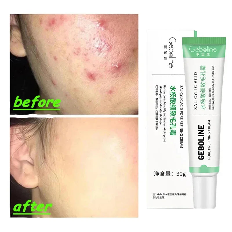 Salicylic Acid Pore Refining and Acne Repair Cream - 2