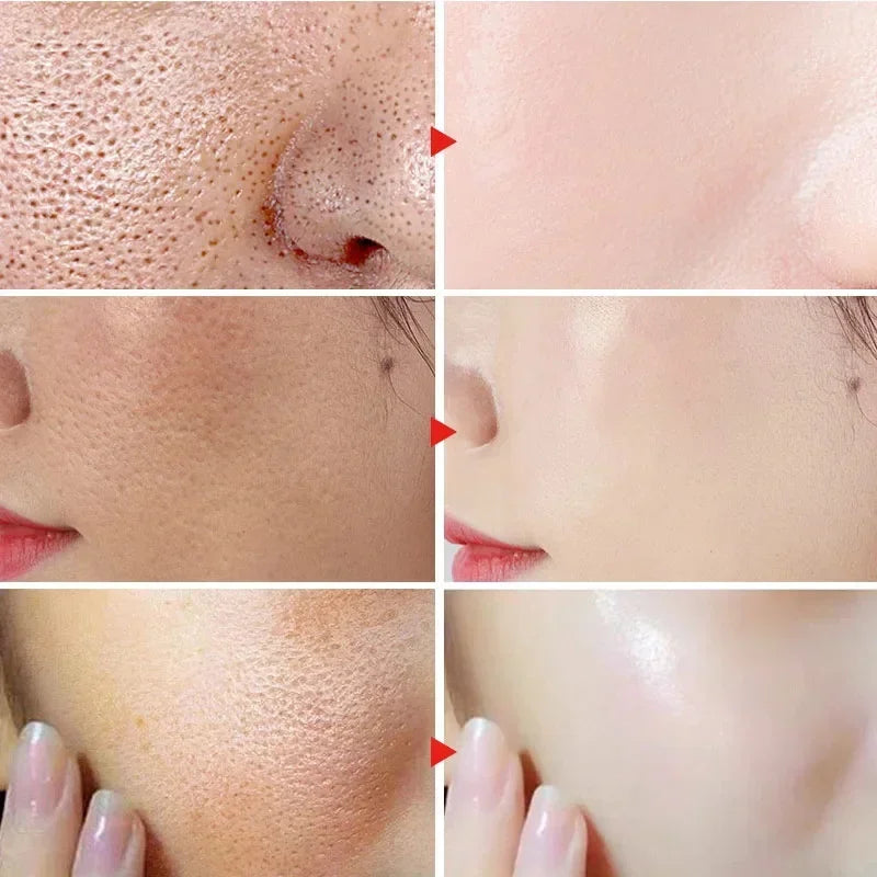 Salicylic Acid Pore Refining and Acne Repair Cream - 12