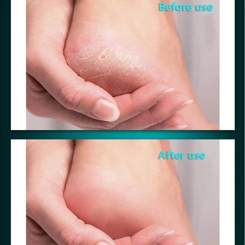 Professional Stainless Steel Foot File for Callus and Dead Skin Removal - 4