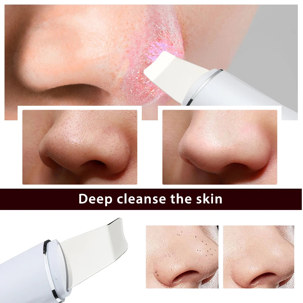 Ultrasonic Facial Skin Scrubber for Deep Pore Cleaning and Lifting - 6