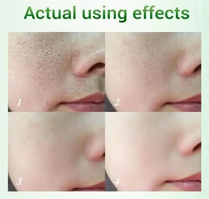 Salicylic Acid Pore Refining and Acne Repair Cream