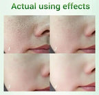 Salicylic Acid Pore Refining and Acne Repair Cream