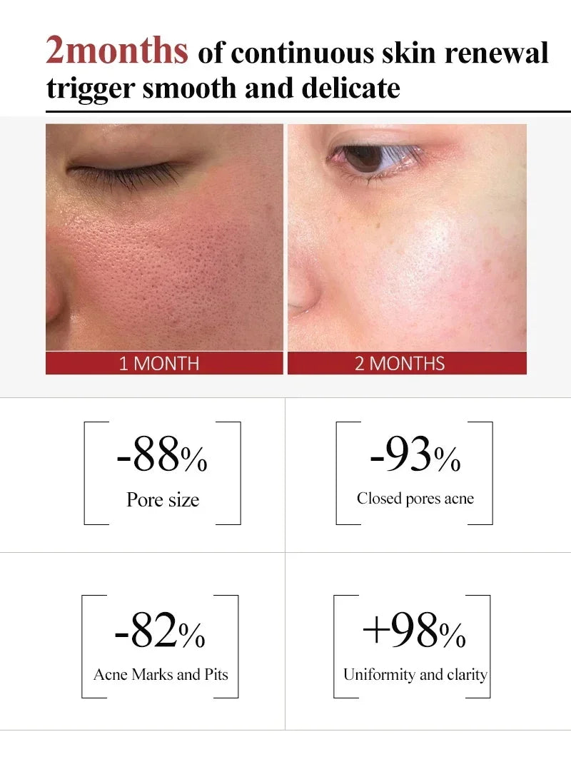 Salicylic Acid Pore Refining and Acne Repair Cream