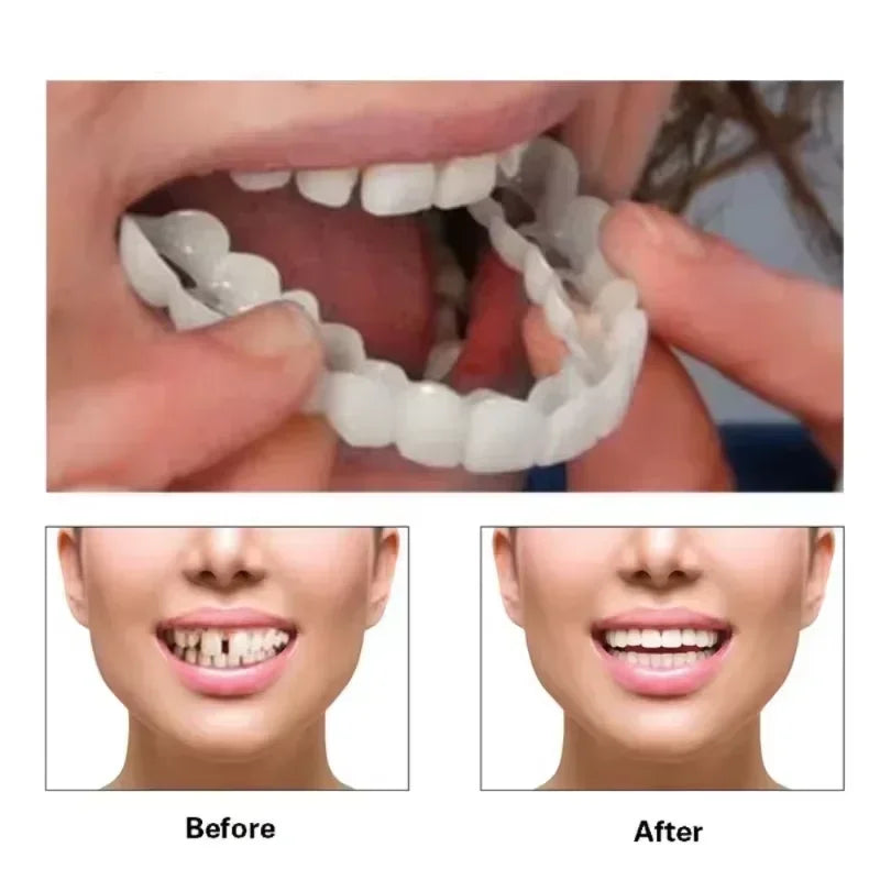 Snap-On Temporary Smile Veneers for Instant Teeth Whitening