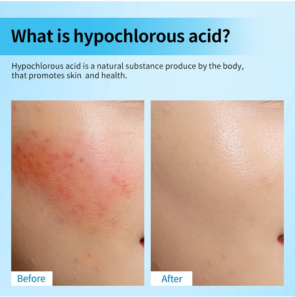 Hypochlorous Acid Facial Spray for Acne and Skin Soothing