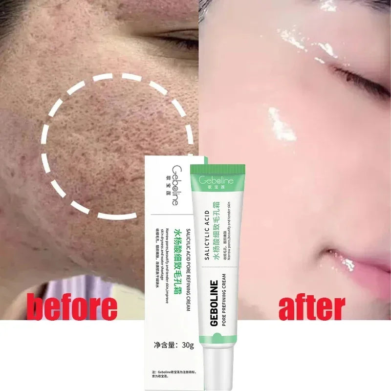 Salicylic Acid Pore Refining and Acne Repair Cream