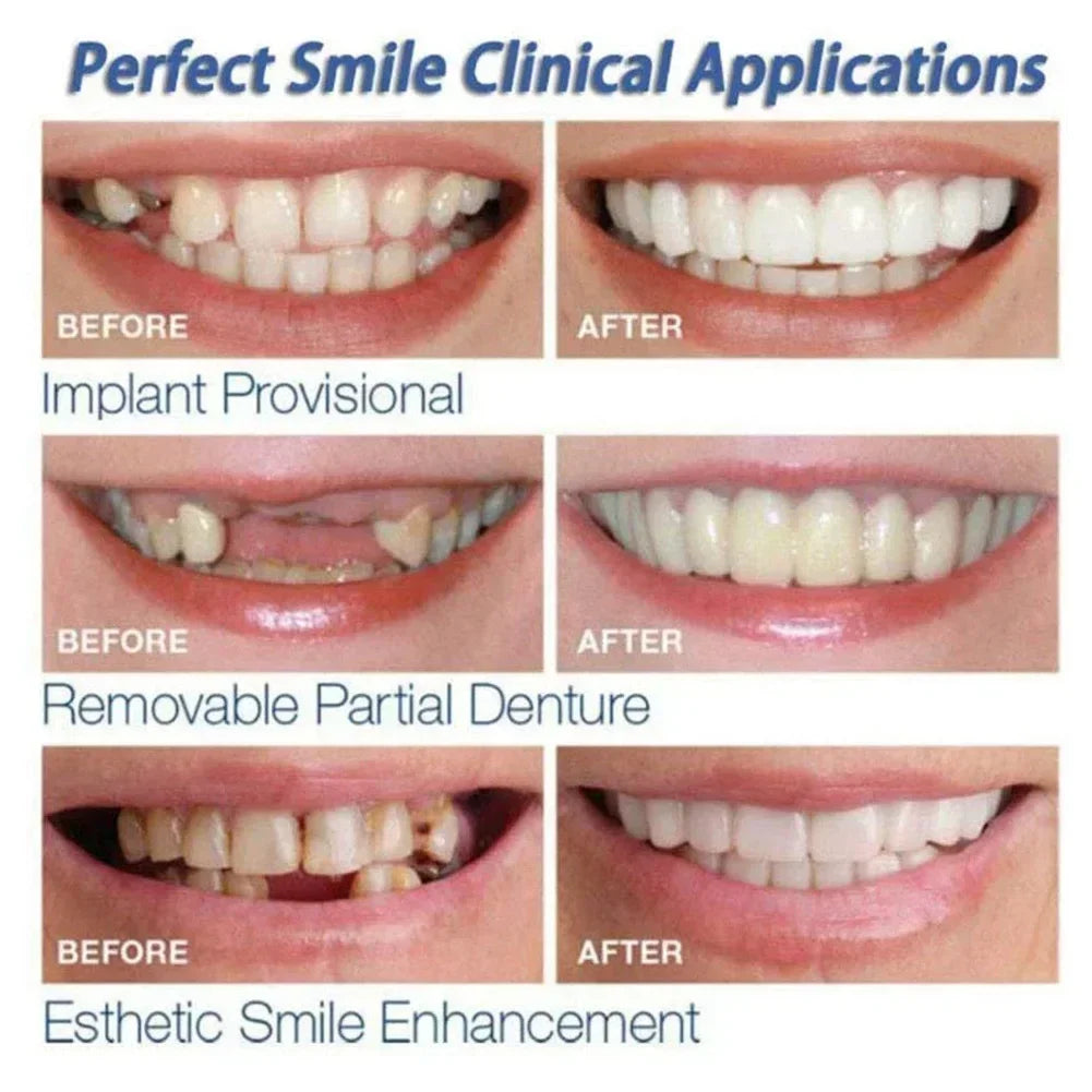 Snap-On Temporary Veneers for Instant Smile Makeover - 3