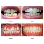 3-Stage Adult Teeth Straightening Alignment Trainer Mouthpiece