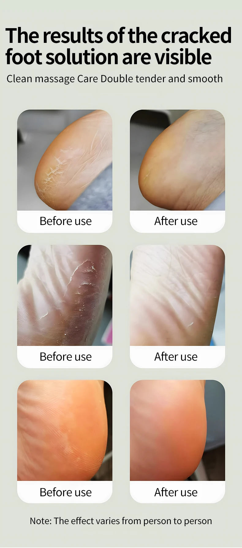 Electric Foot Callus Remover for Smooth Feet