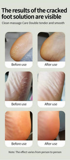 Electric Foot Callus Remover for Smooth Feet