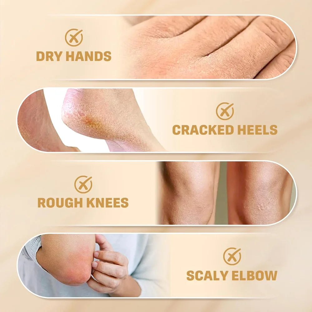 Urea Cream 60g Cracked Heel Repair Moisturizer for Dry Skin Hands Feet