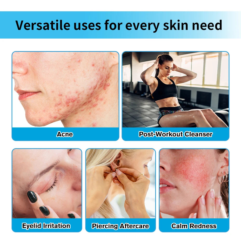 Hypochlorous Acid Facial Spray for Acne and Skin Soothing